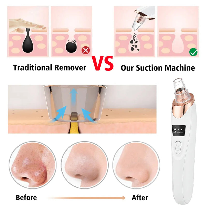 DermiCare™ Blackhead Vacuum Pore Cleaner